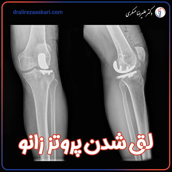 شل شدن پروتز زانو - دکتر علیرضا عسکری