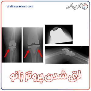 لق شدن پروتز زانو - دکتر علیرضا عسکری