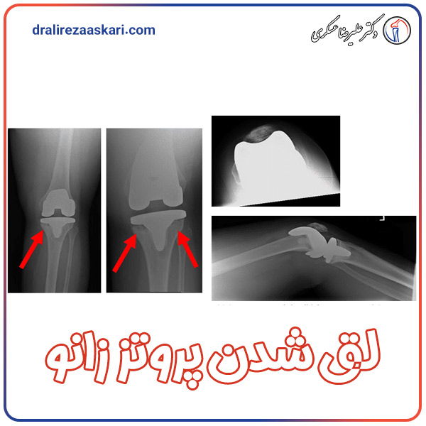 لق شدن پروتز زانو - دکتر علیرضا عسکری