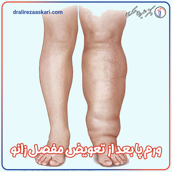 دلایل ورم پا بعد از تعویض مفصل زانو   - دکتر عسکری