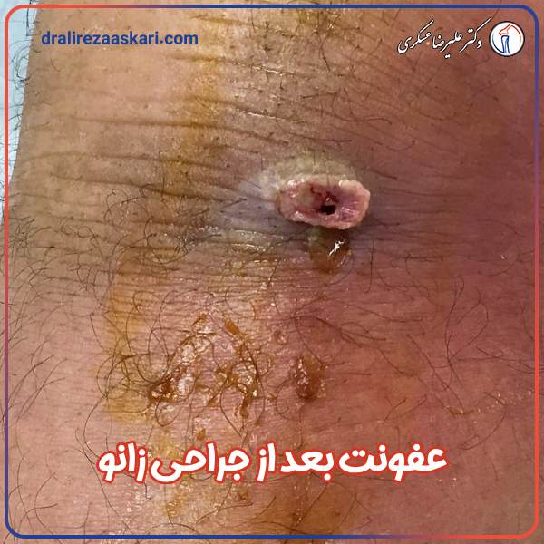 عفونت بعد از جراحی زانو - دکتر علیرضا عسکری