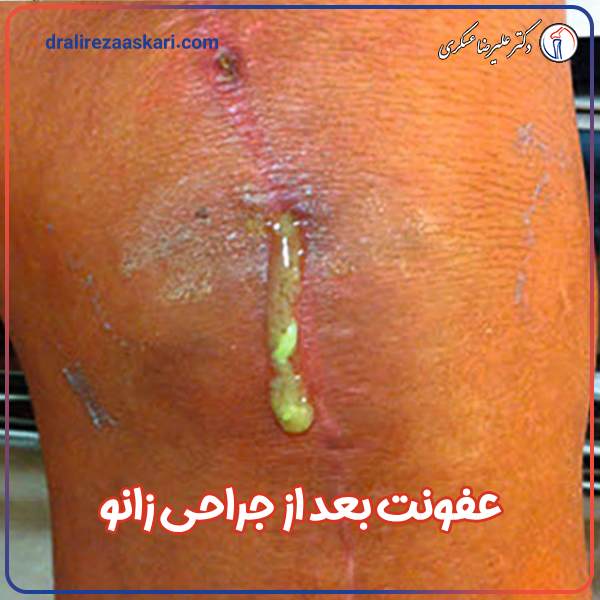 عفونت بعد از جراحی زانو - دکتر علیرضا عسکری
