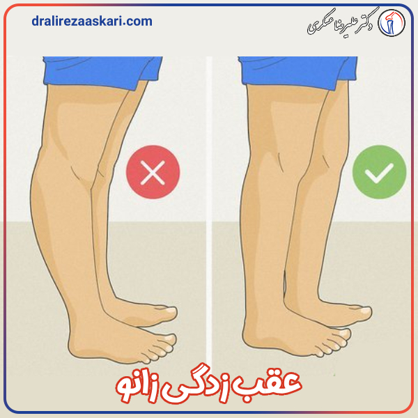 عقب زدگی زانو - دکتر علیرضا عسکری