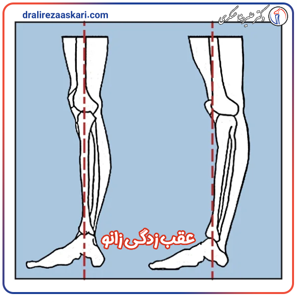 عقب زدگی زانو - دکتر علیرضا عسکری