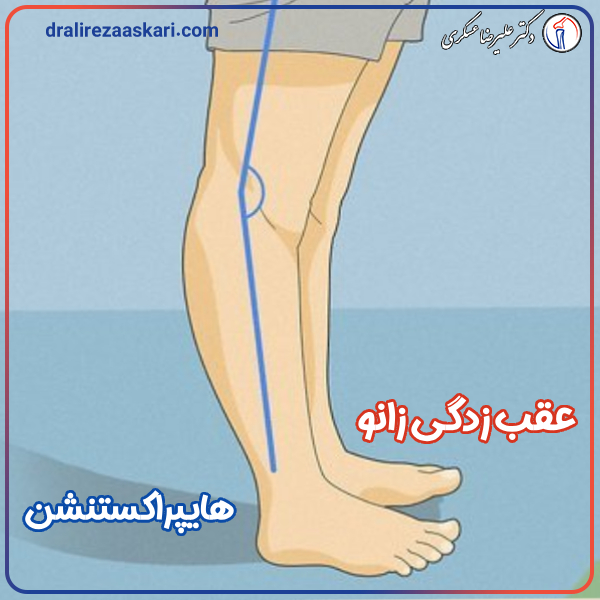عقب زدگی زانو - دکتر علیرضا عسکری