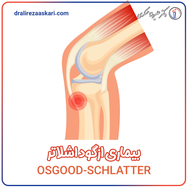 بیماری ازگود اشلاتر - دکتر عسکری