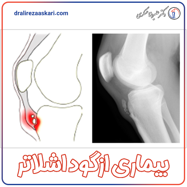بیماری ازگود اشلاتر - دکتر عسکری