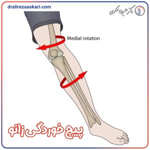 پیچ خوردگی زانو - دکتر علیرضا عسکری