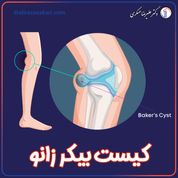 کیست بیکر زانو - دکتر علیرضا عسکری