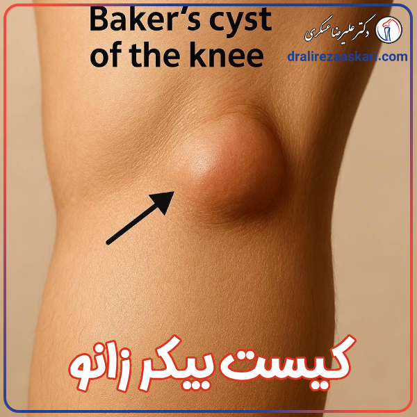 کیست بیکر زانو - دکتر علیرضا عسکری