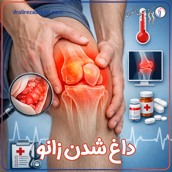 داغ شدن زانو - دکتر علیرضا عسکری