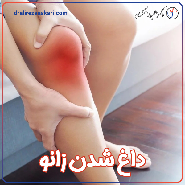 داغ شدن زانو - دکتر علیرضا عسکری