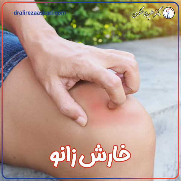 خارش زانو - دکتر علیرضا عسکری