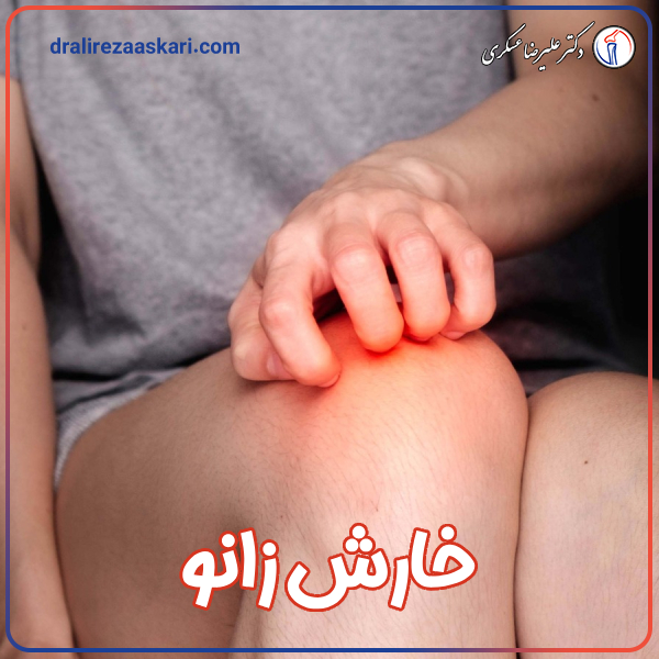 خارش زانو - دکتر علیرضا عسکری