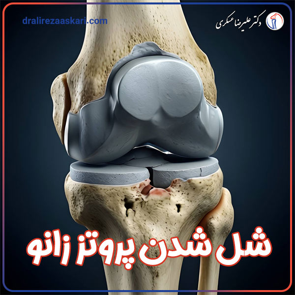 شل شدن پروتز زانو - دکتر عسکری