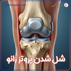 شل شدن پروتز زانو - دکتر علیرضا عسکری