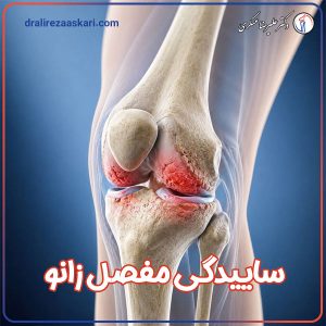 ساییدگی مفصل زانو - دکتر عسکری