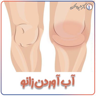 knee-effusion–1 آب آوردن زانو - دکتر علیرضا عسکری